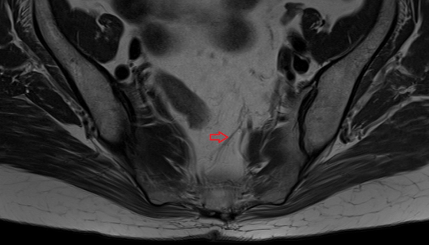 superior rectal artery  MRI axial image  MRI  axial  anatomy  image-img-00000-00000_00001