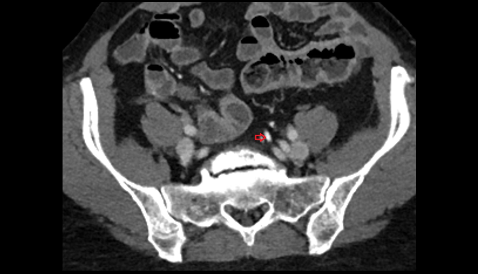 superior rectal vein CT axial image 0