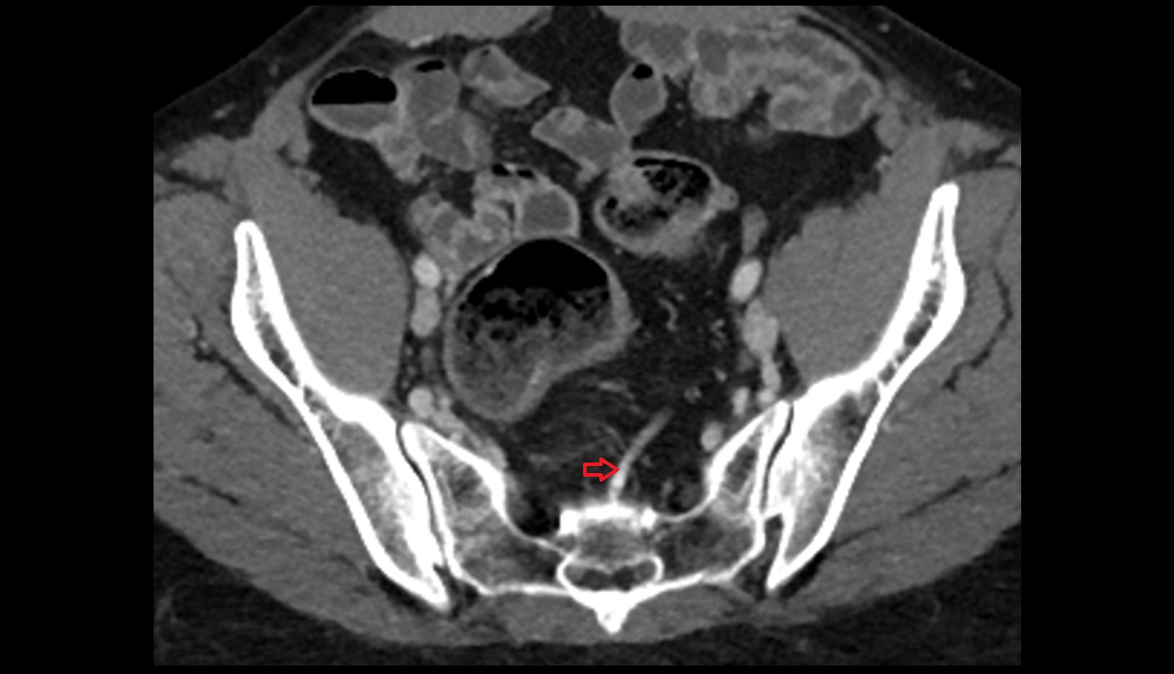 superior rectal vein CT axial image  3