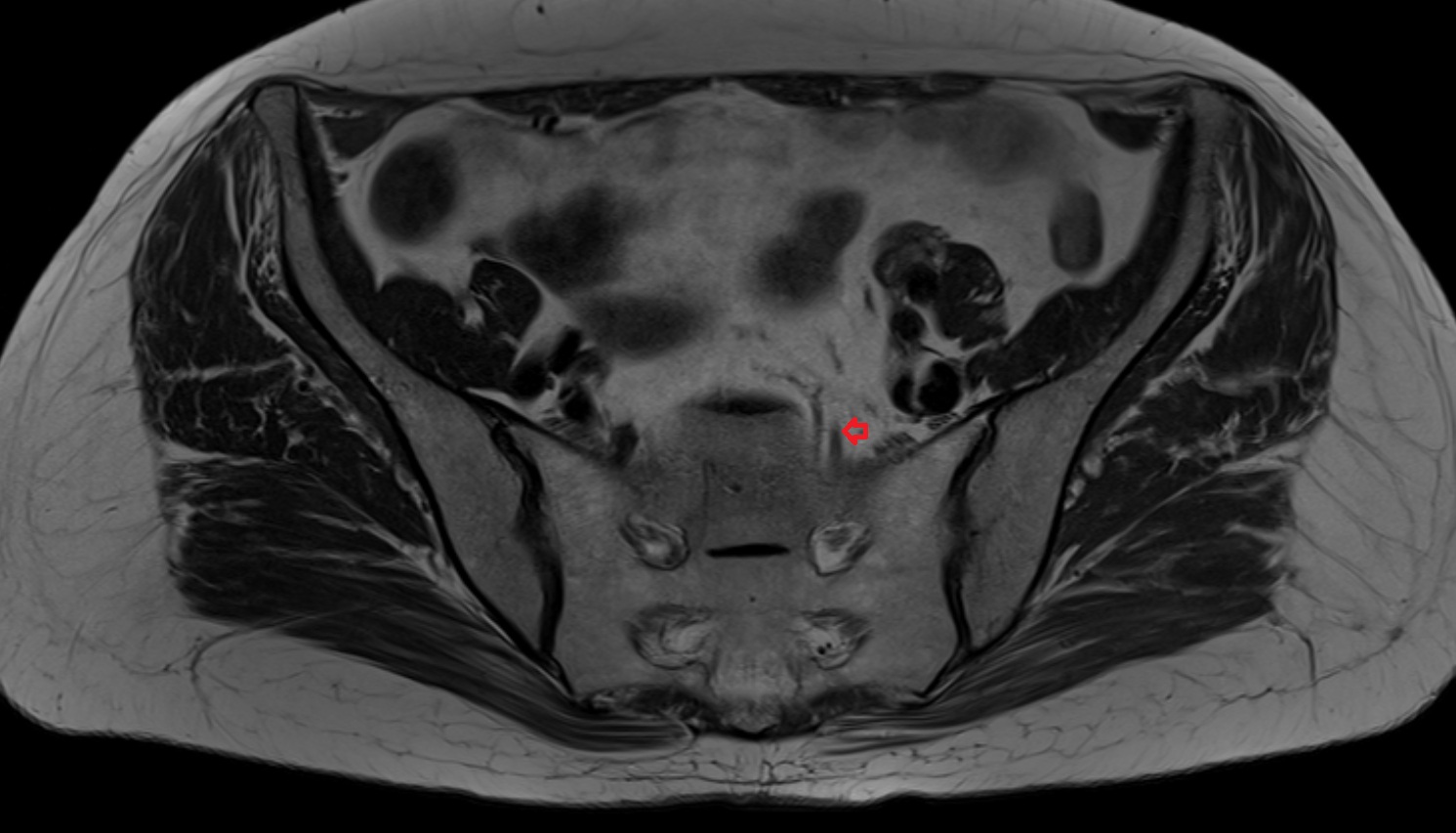 superior rectal vein  MRI  axial  anatomy  image-img-00000-00000