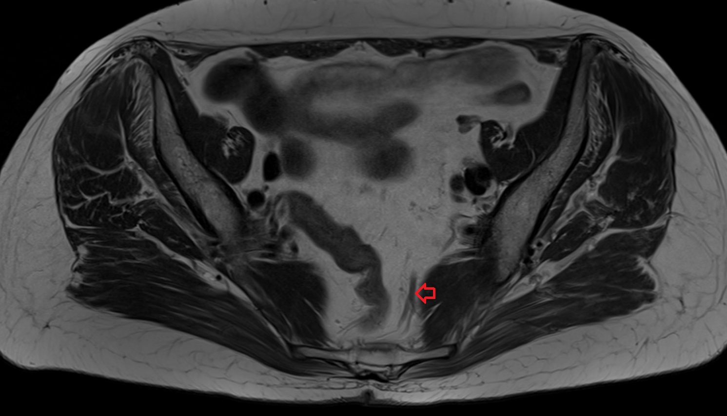 superior rectal vein  MRI  axial  anatomy  image-img-00000-00000_00001