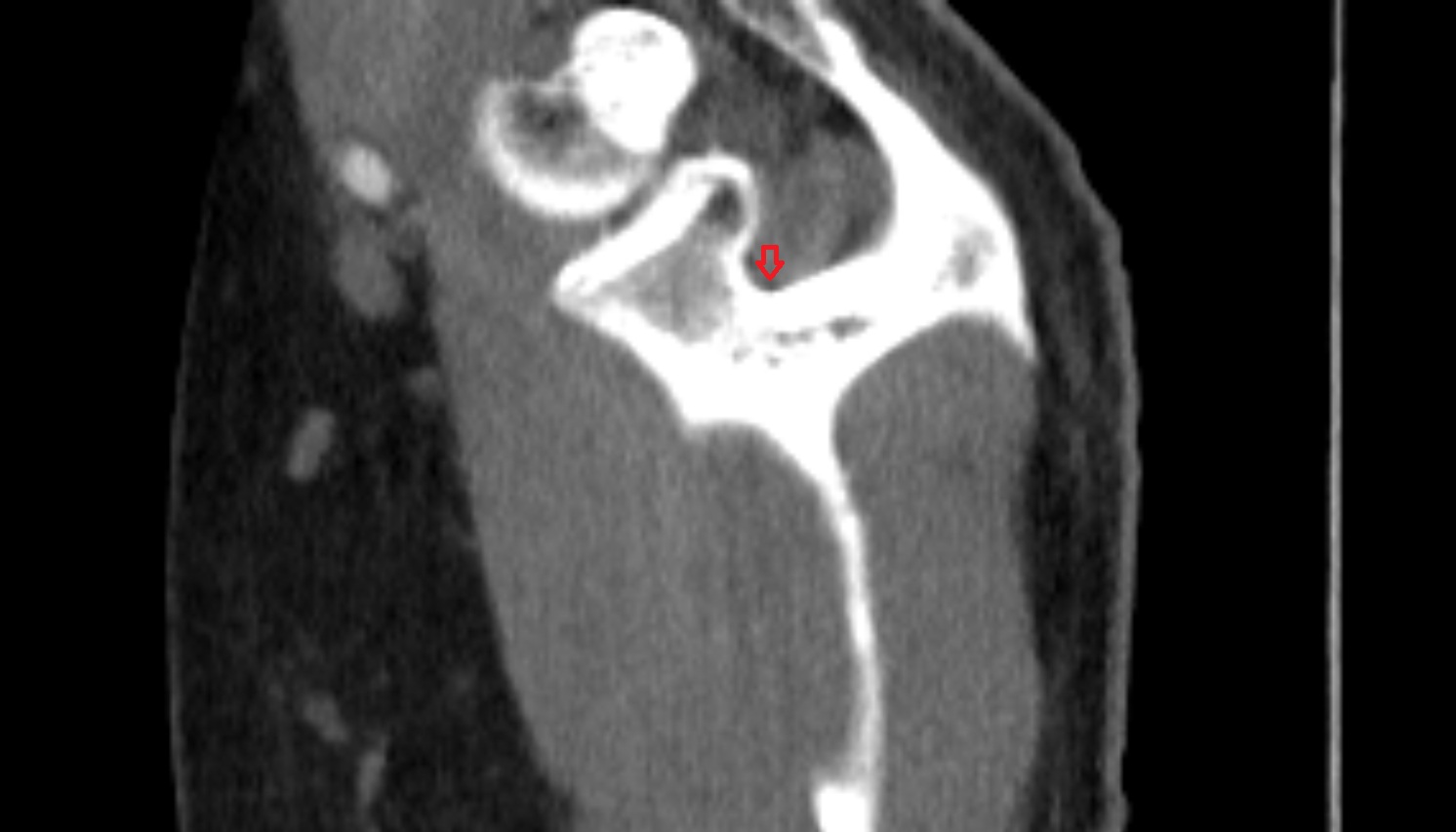 supraspinous fossa of scapula CT sag  image -img-00000-00000