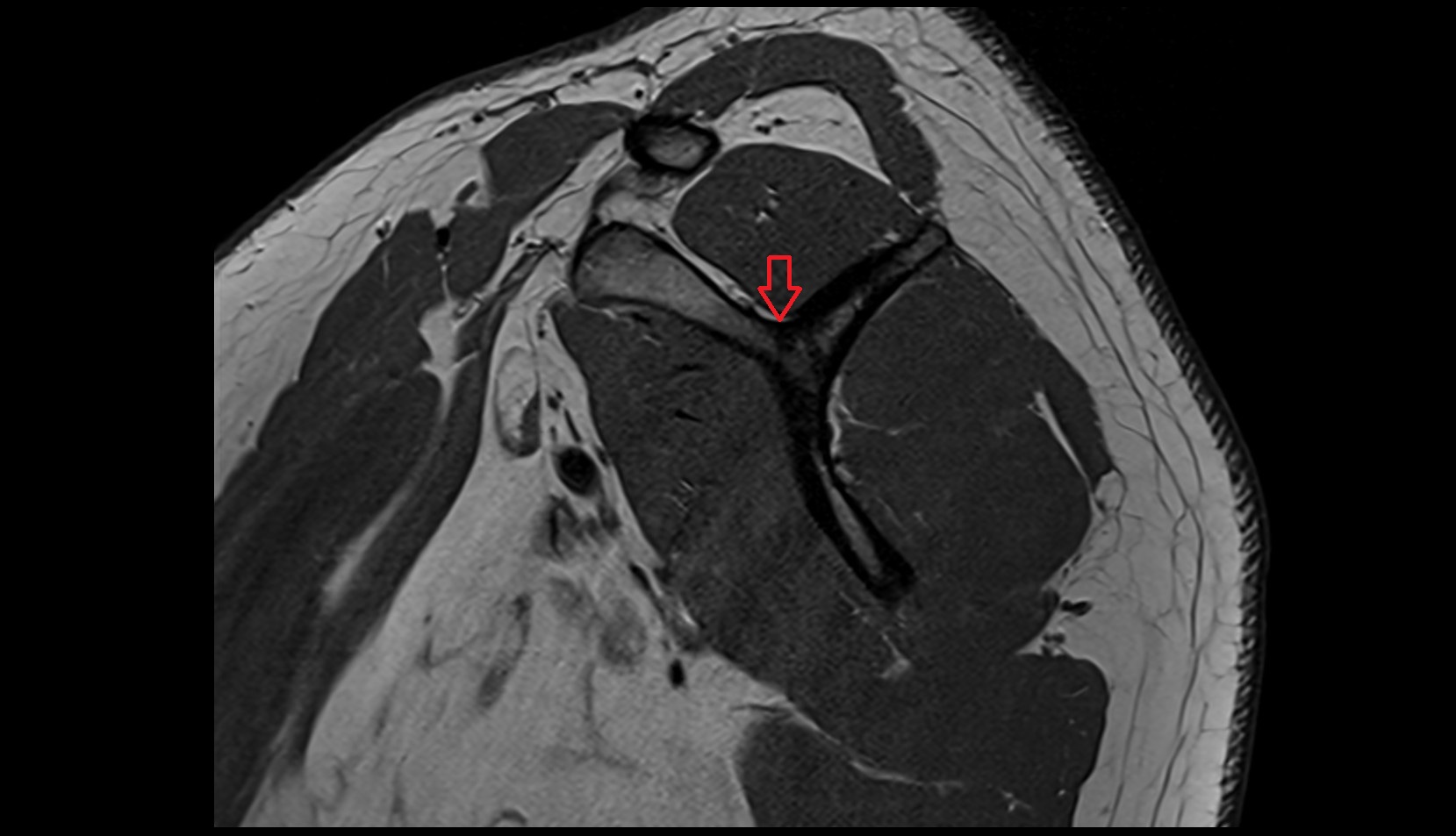 supraspinous fossa of scapula MRI sag image