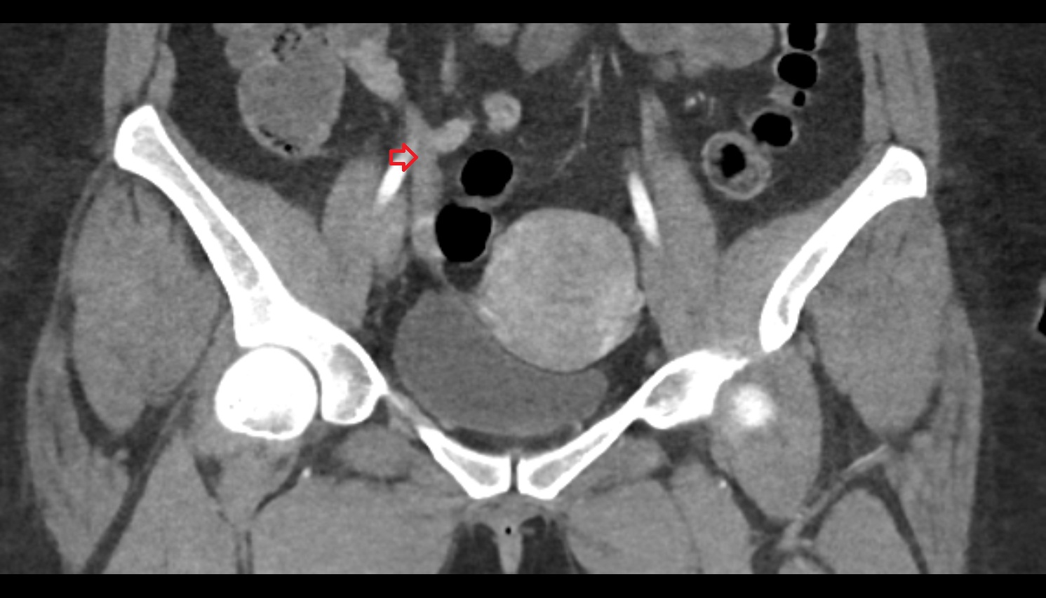 suspensory ligament of ovary  CT  coronal  image anatomy  image-img-00000-00000