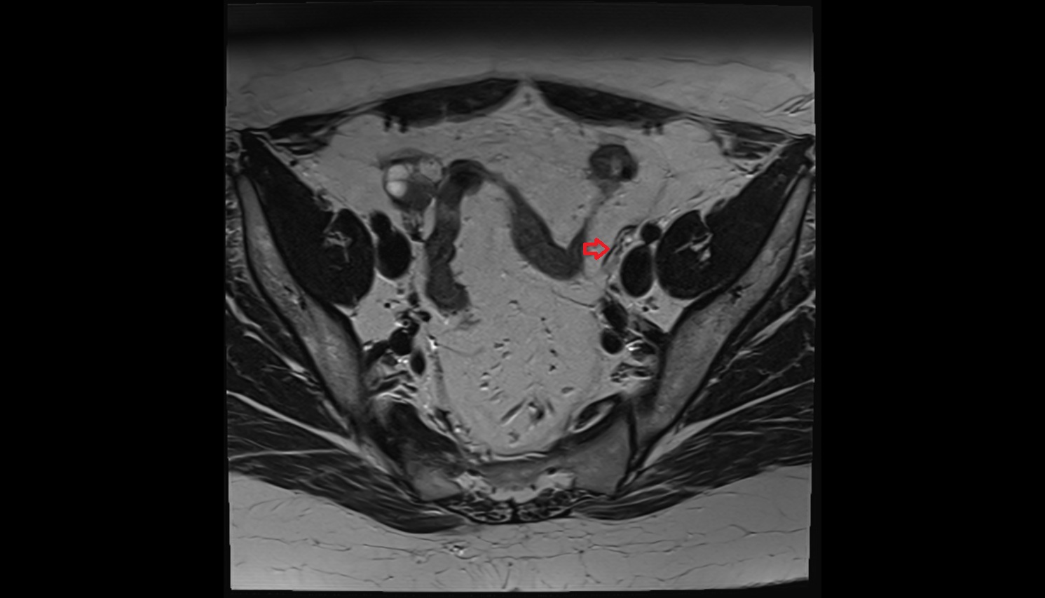 suspensory ligament of ovary mri axial image  image anatomy  image-img-00000-00000