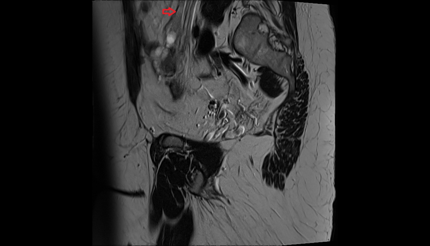 suspensory ligament of ovary mri sagittal image  image anatomy  image-img-00000-00000