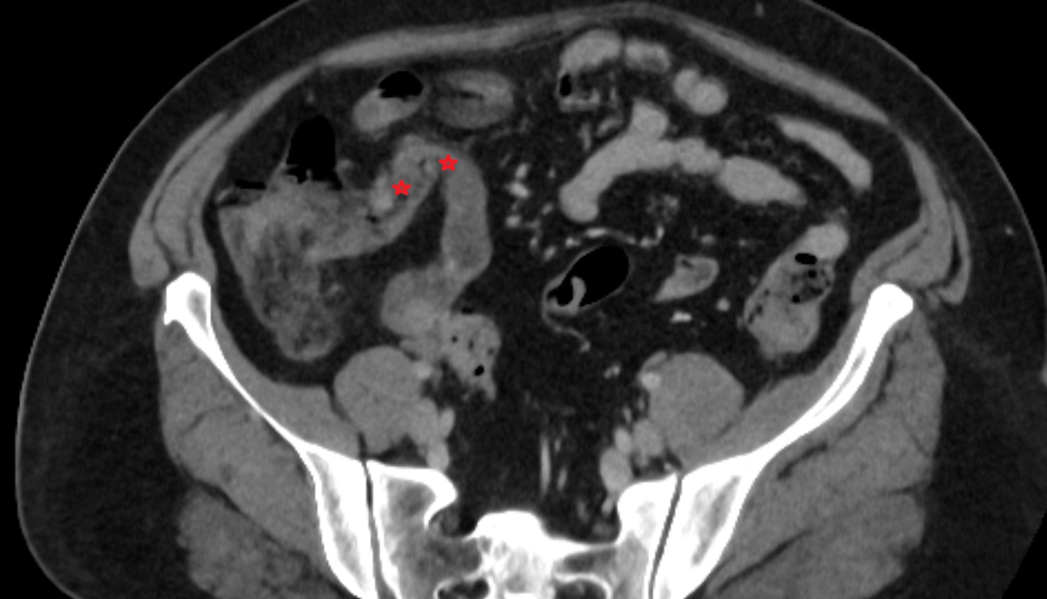 terminal ileum  CT axial  anatomy  image -img-00000-00000