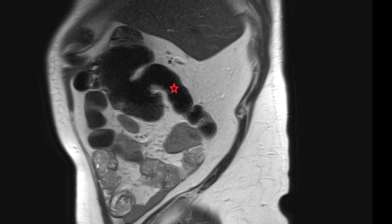 terminal ileum MRI sag  anatomy  image -img-00000-00000
