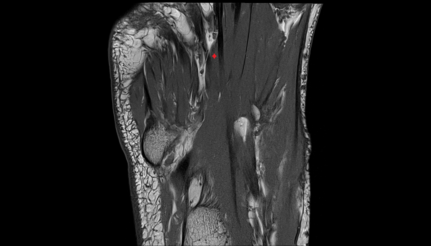 third Lumbrical Muscle of Foot  axial cross sectional anatomy 3T MRI AI enhanced radiology image-img-00000-00000