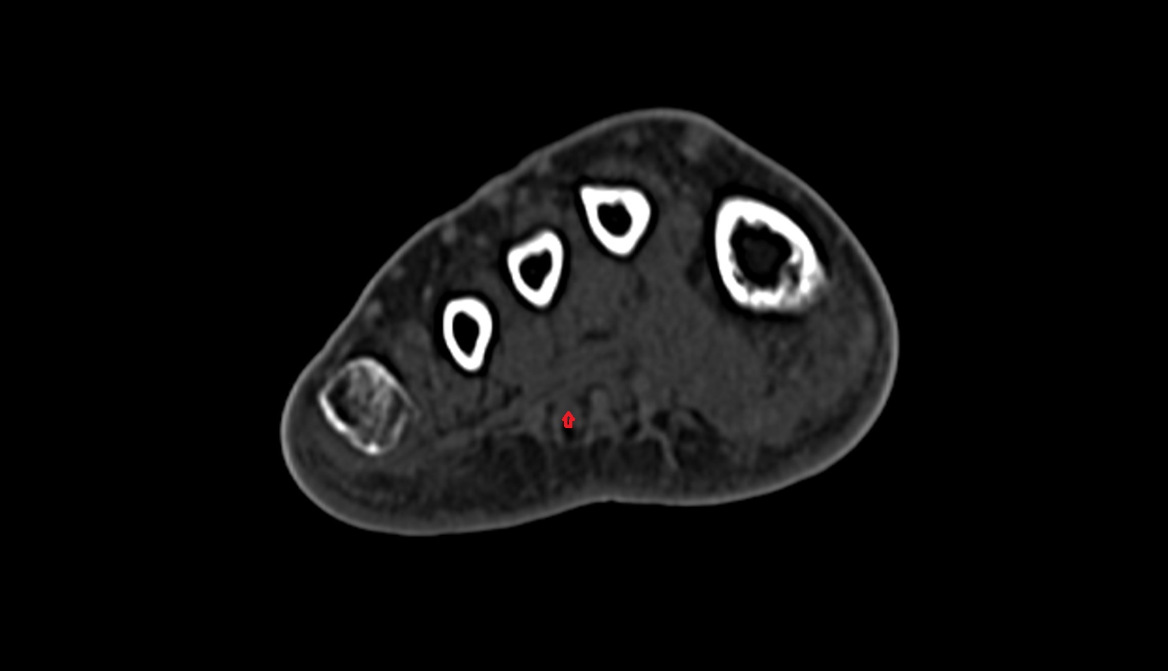 third Lumbrical Muscle of Foot axial ct image
