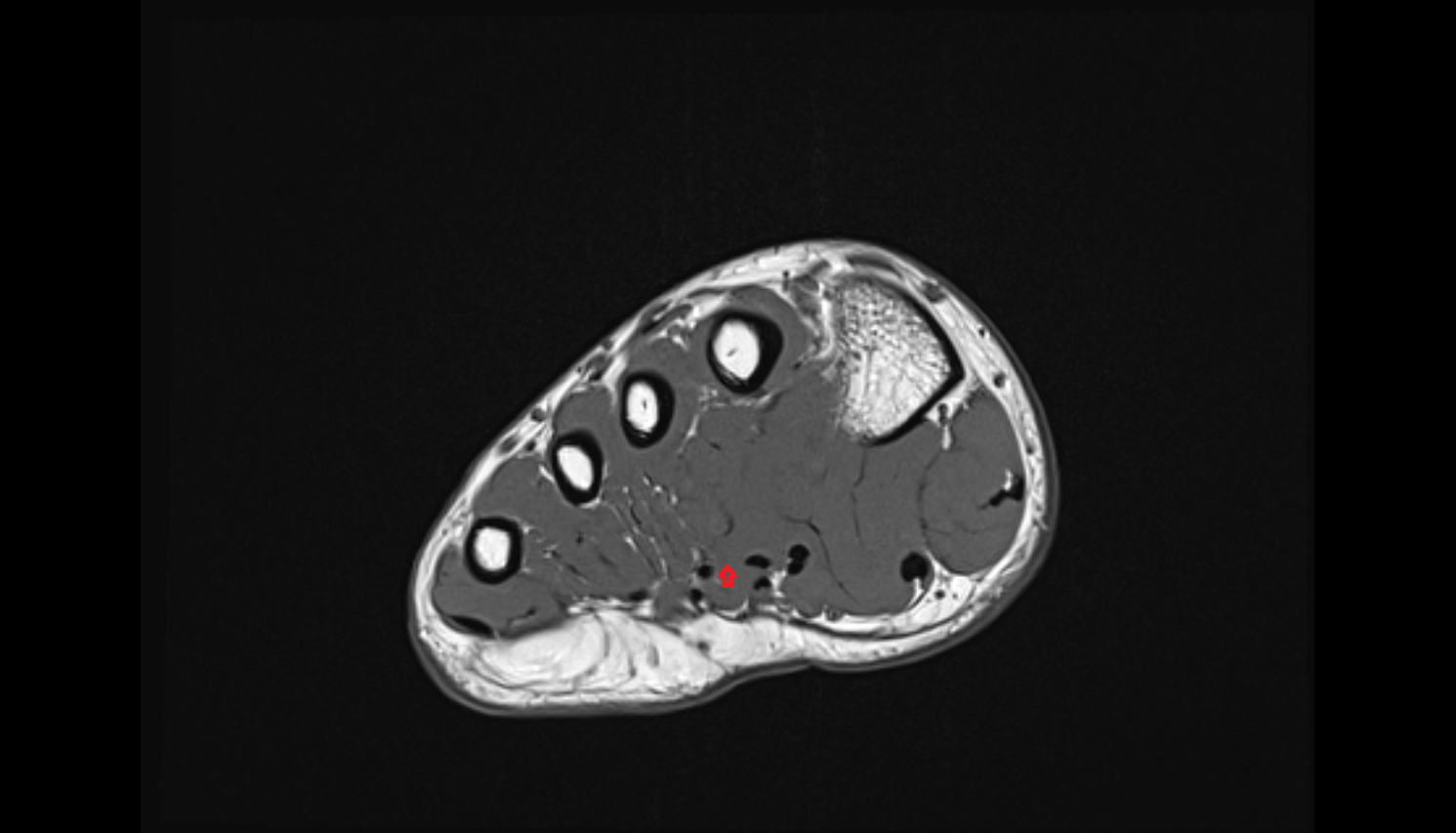 third Lumbrical Muscle of the Foot  axial cross sectional anatomy 3T MRI AI enhanced radiology image-img-00000-00000_00001