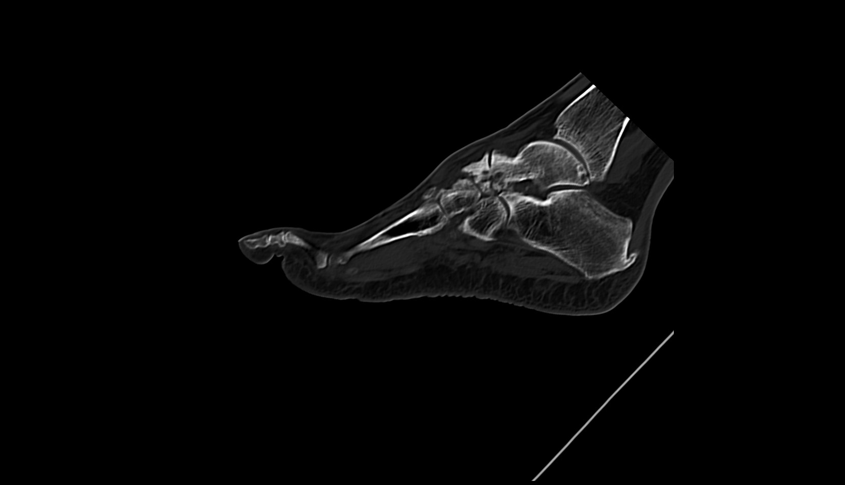 third Metatarsal Bone ct sag