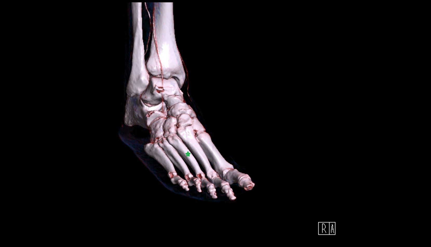 third Metatarsal Bone ct vrt image