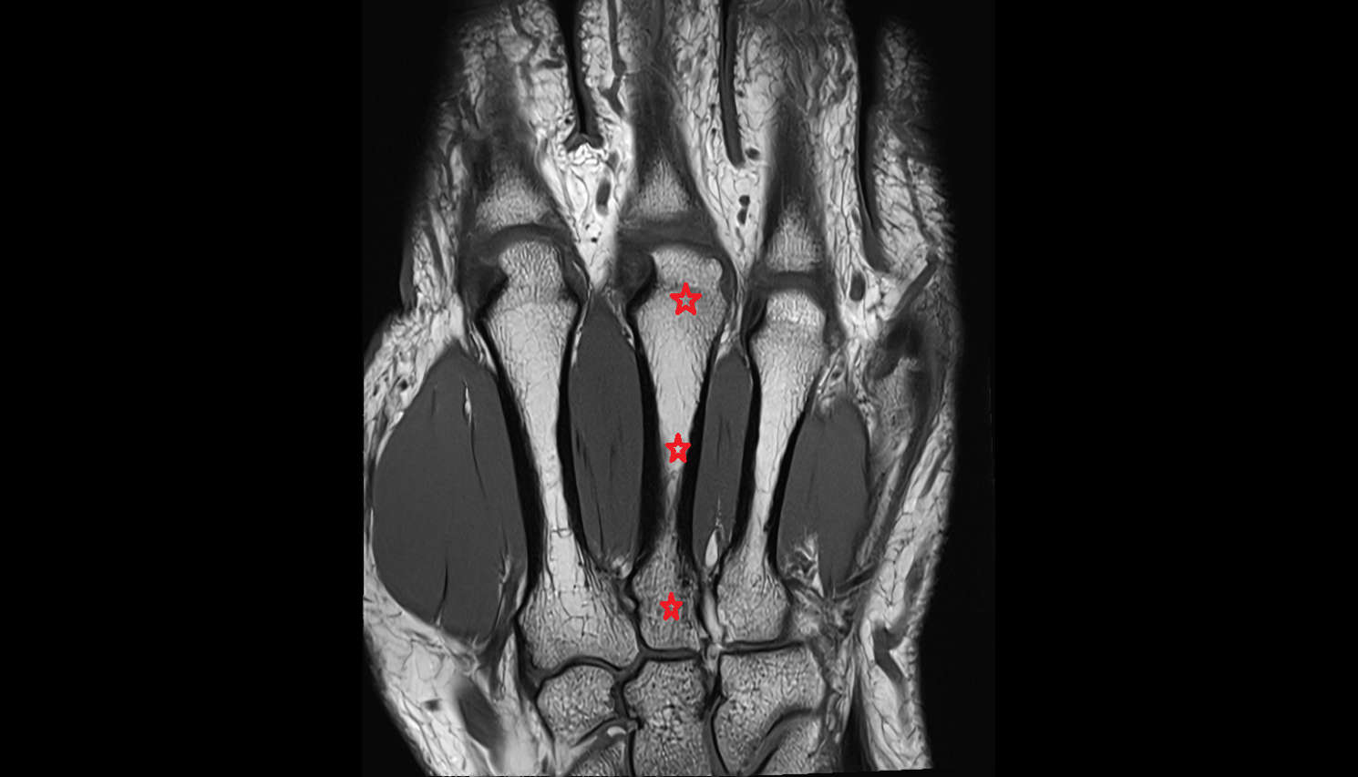 third metacarpal bone (metacarpal III)  coronal cross sectional anatomy 3T MRI AI enhanced radiology image-img-00000-00000
