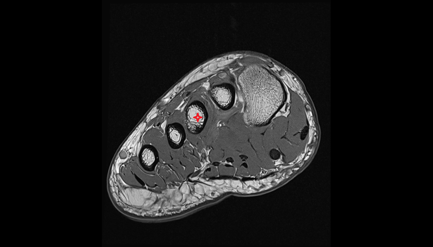 third metatarsal bone axial cross sectional anatomy 3T MRI AI enhanced radiology image-img-00000-00000
