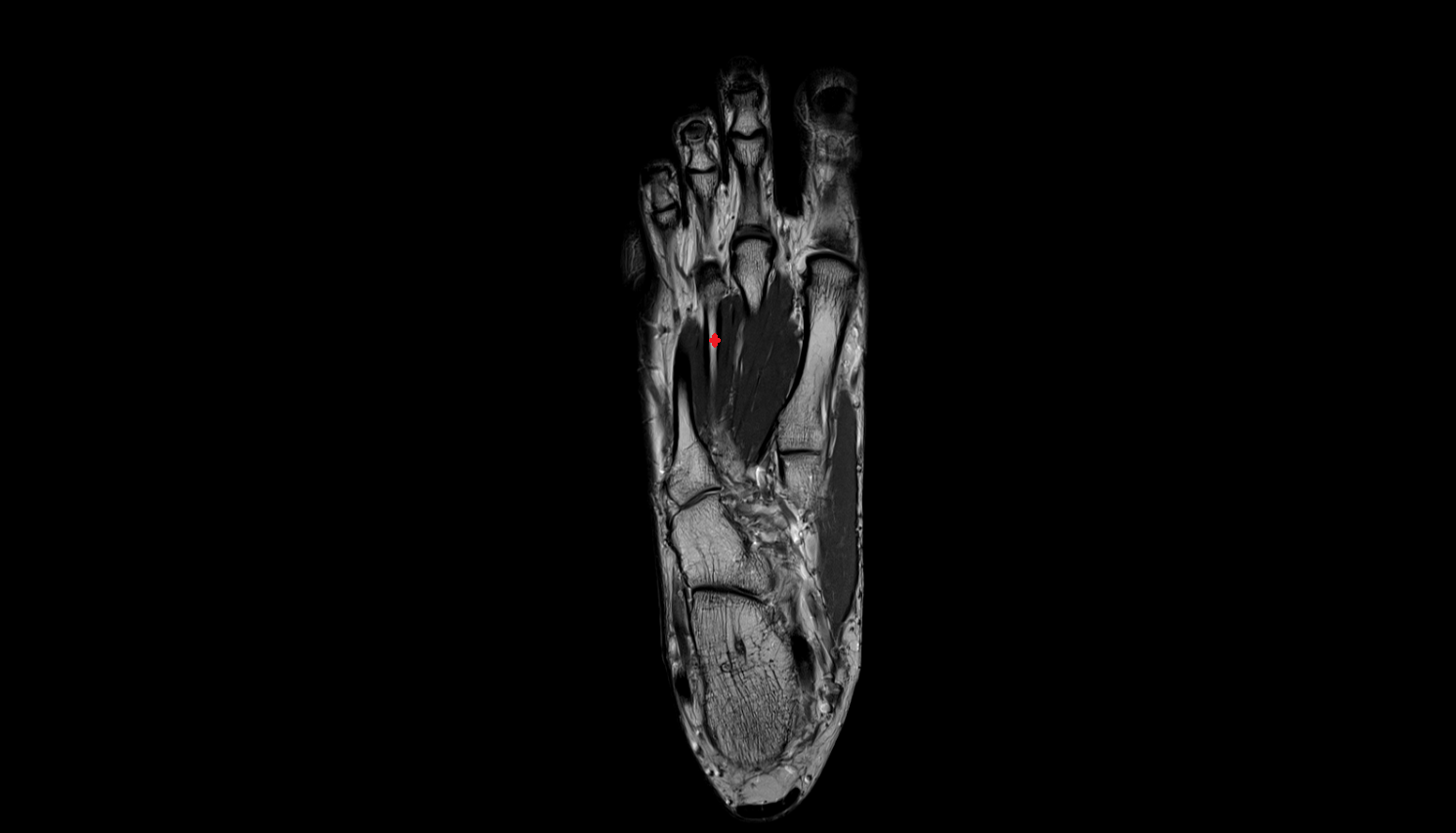 third  metatarsal bone coronal cross sectional anatomy 3T MRI AI enhanced radiology image-img-00000-00000