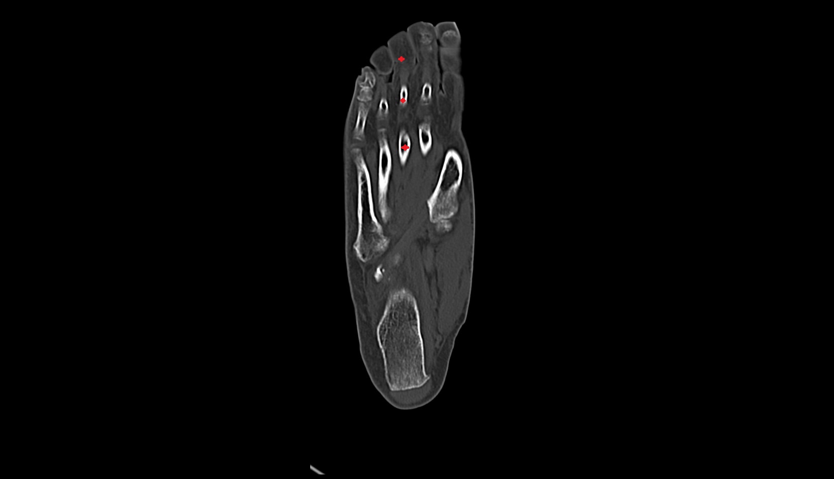 third  toe CT coronal image