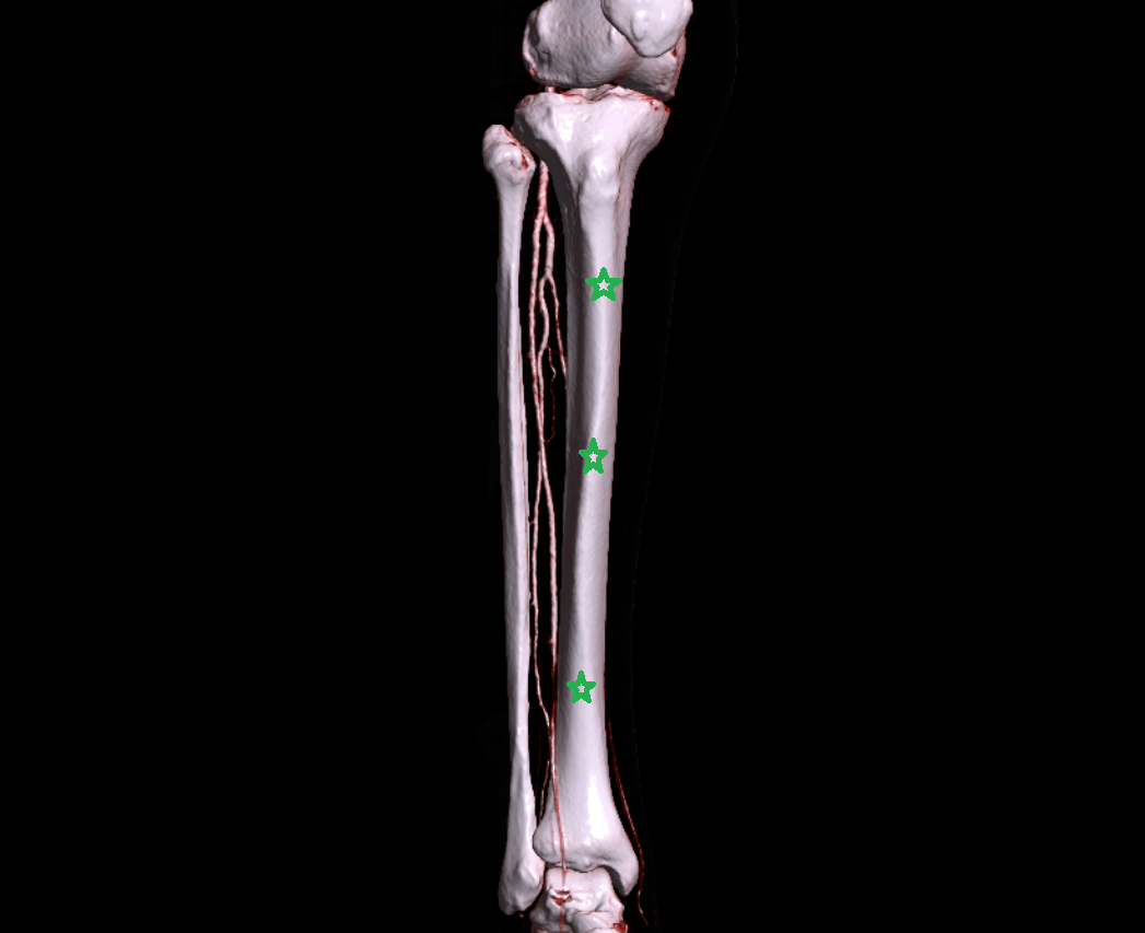 tibial shaft anatomy labelled image-img-00000-00000