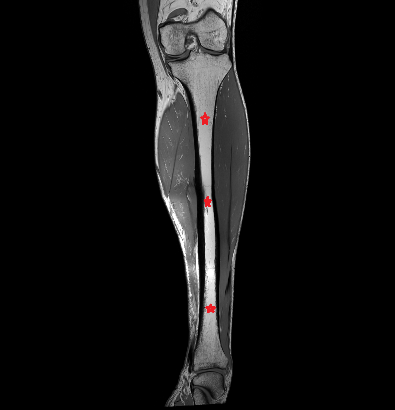tibial shaft mri  anatomy labelled image-img-00000-00000