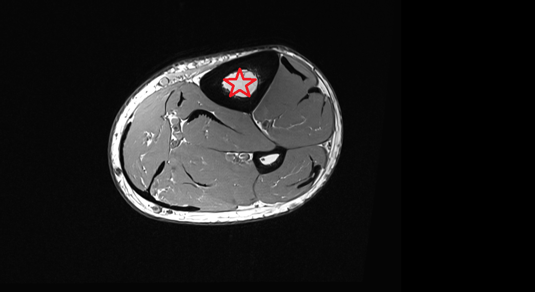 tibial shaft mri  anatomy labelled image-img-00000-00000_00001