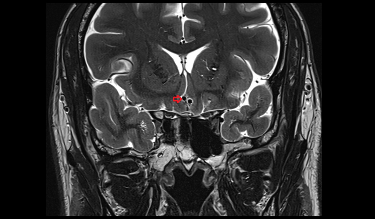Anterior cerebral artery coronal T2 3T MRI  image