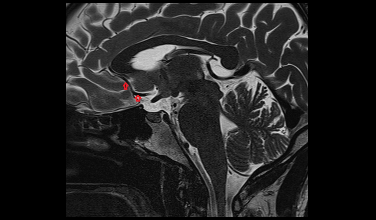 Anterior cerebral artery sagittal T2 3T MRI  image