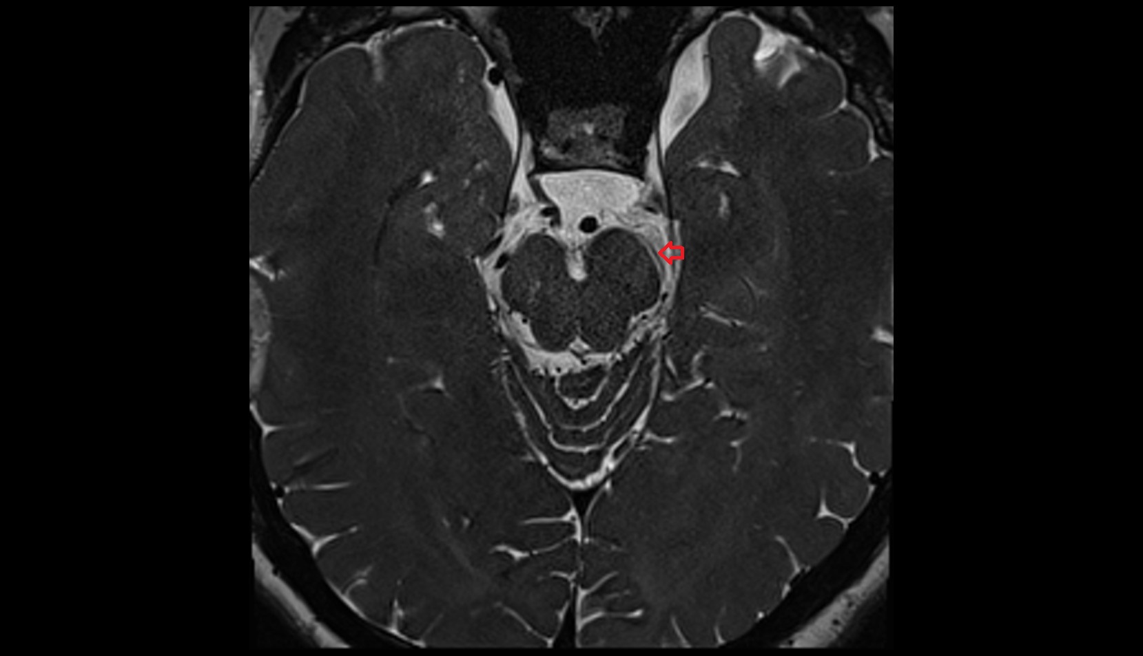 MRI images