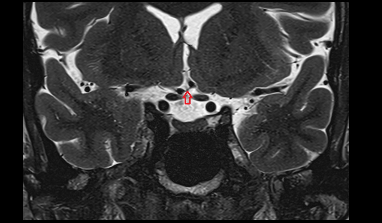 Anterior communicating artery MRI T2 coronal image