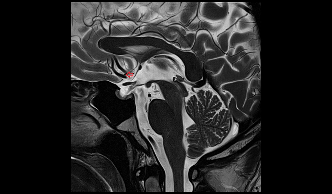 Anterior communicating artery MRI T2 sagittal  image