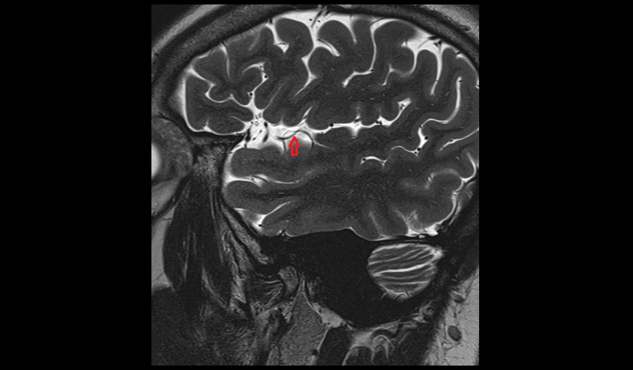 Anterior temporal artery MRI 3T sagittal image
