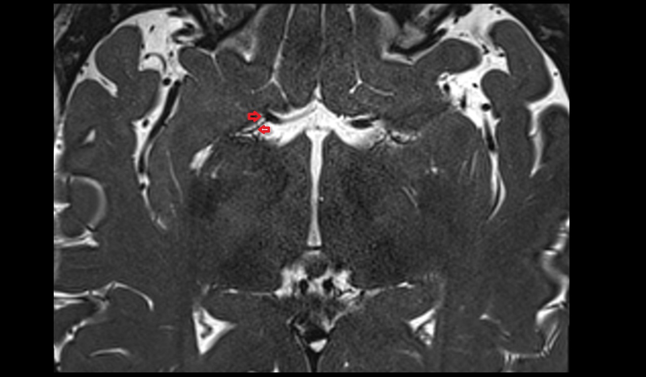 Anteromedial central (perforating) arteries axil 3t mri image