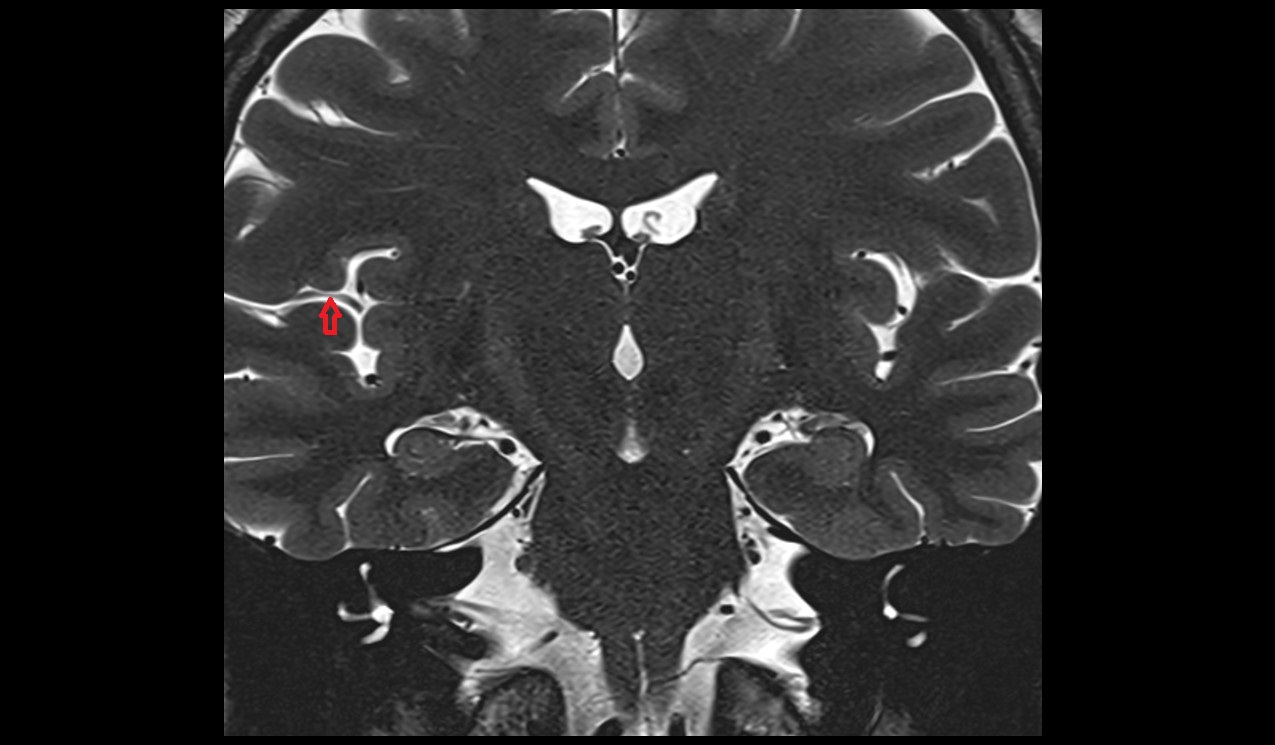 Artery of central sulcus MRI 3T coronal image