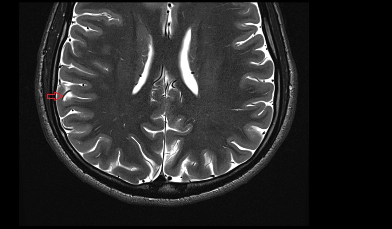 Artery to angular gyrus MRI 3T axial image