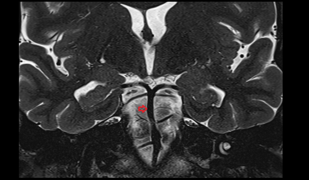 Basilar artery MRI T2 coronal 3t image