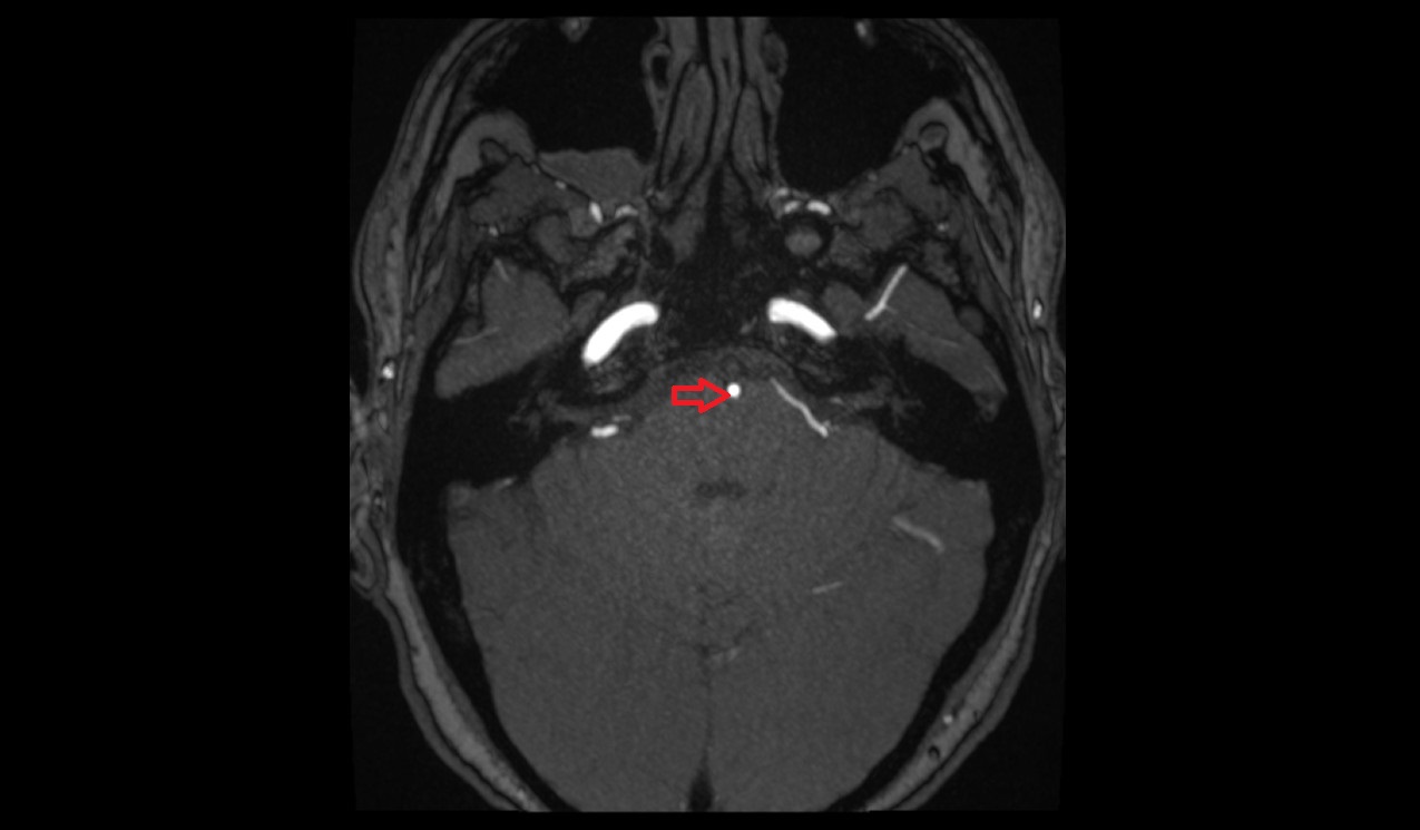Basilar artery MRI TOF axial image