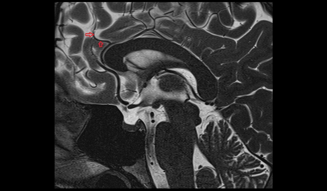 Callosomarginal artery MRI 3T sagittal image
