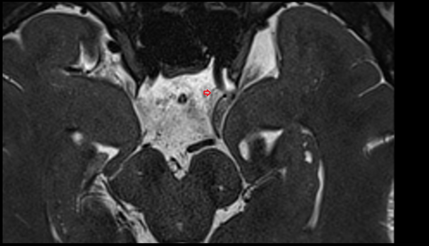 Inferior hypophyseal artery MRI 3T AXIAL IMAGE 1
