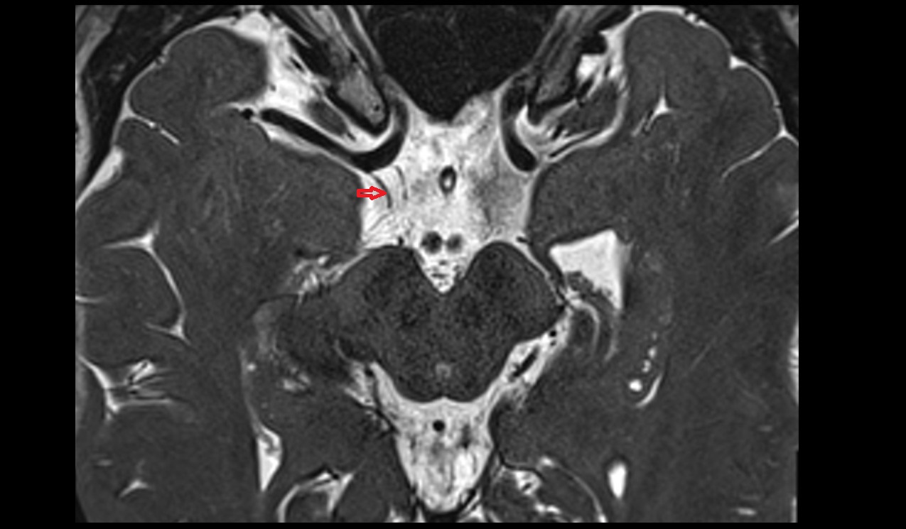 Inferior hypophyseal artery MRI 3T axial image