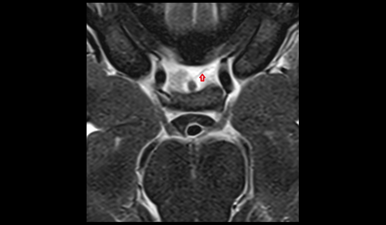 Inferior hypophyseal artery MRI axial 3t image