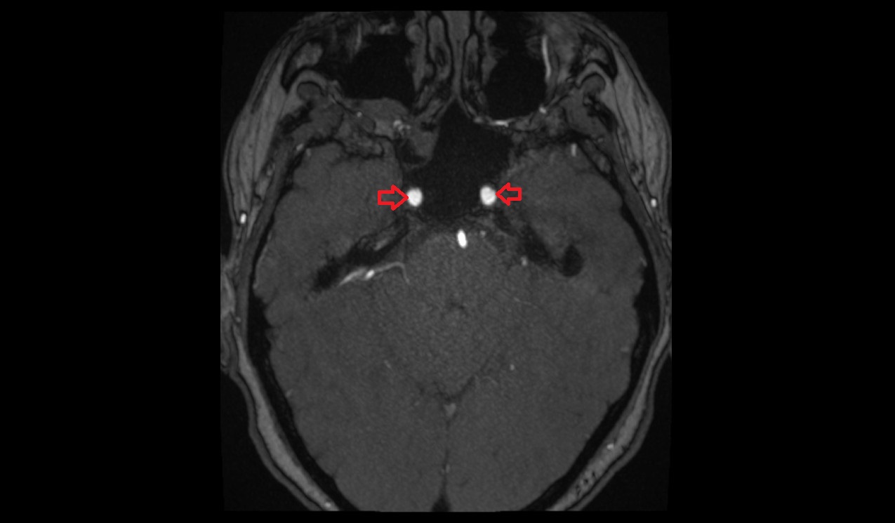 Internal carotid artery MRI TOF axial image