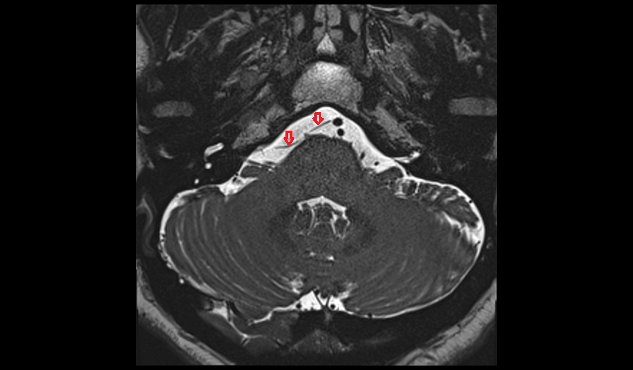 Labyrinthine artery MRI 3T axial t2 image