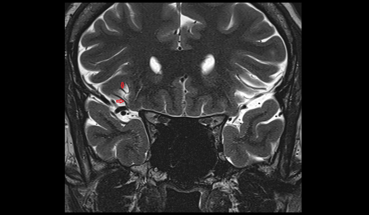 Lateral frontobasal  (orbitofrontal) artery coronal 3t image
