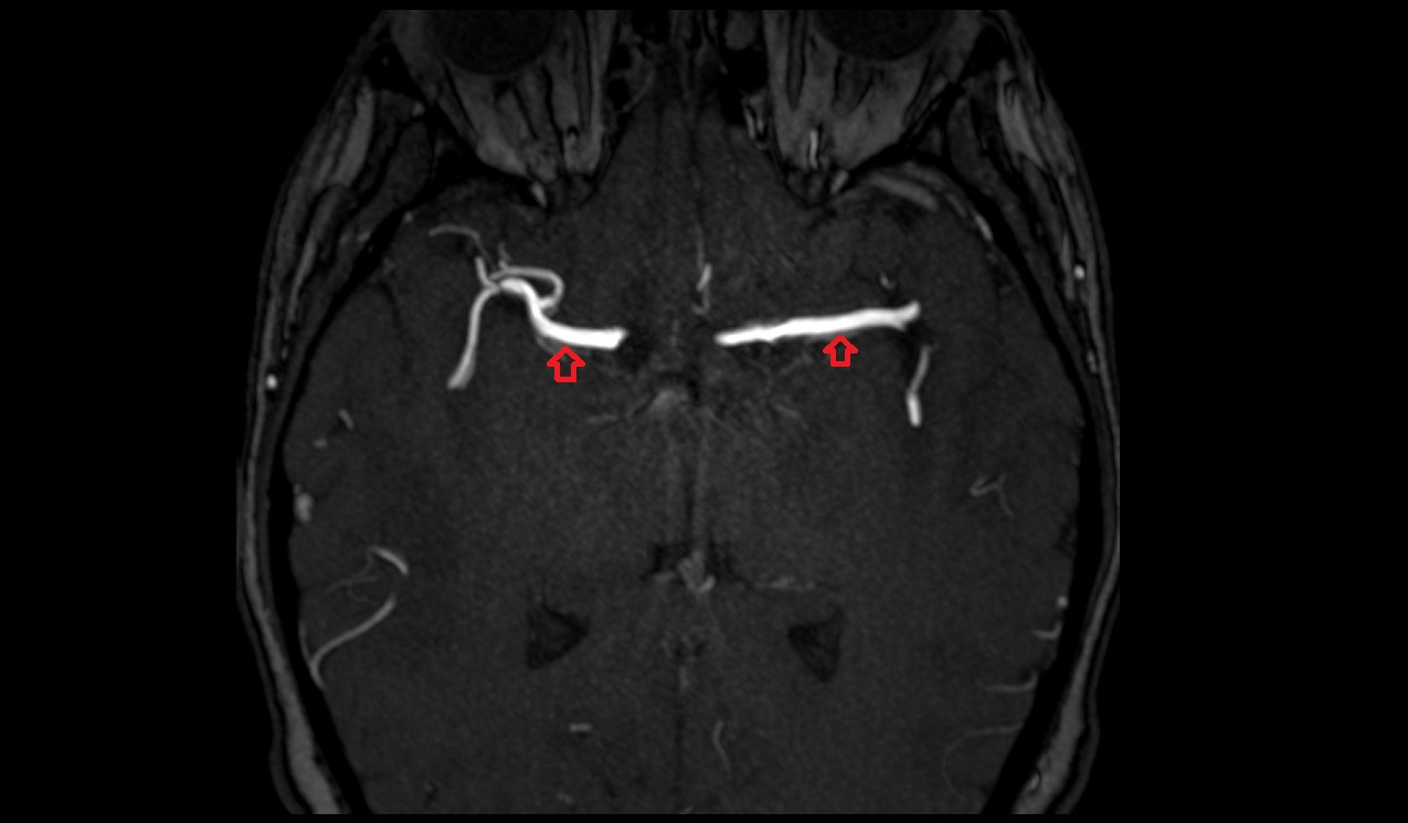 Middle cerebral artery (Sylvian artery) MRI axial TOF image