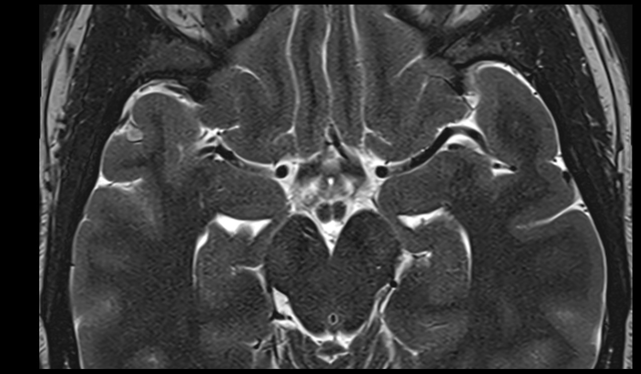 Middle cerebral artery MRI T2 axial image