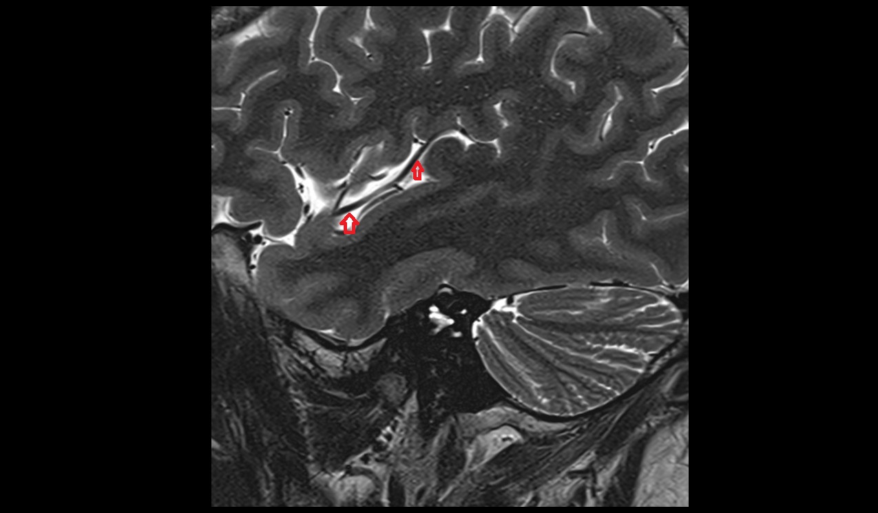 Middle cerebral artery MRI T2 sagittal image