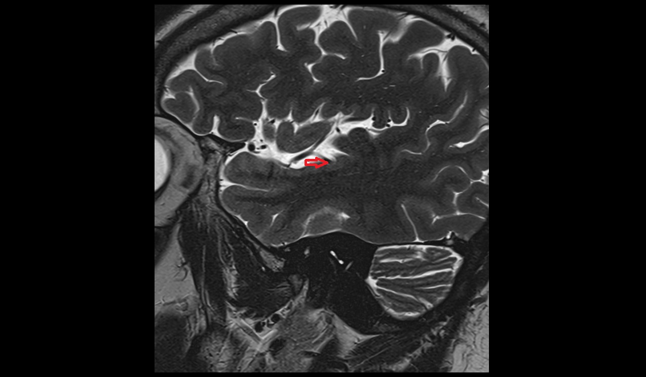 Middle temporal artery MRI 3T sagittal image