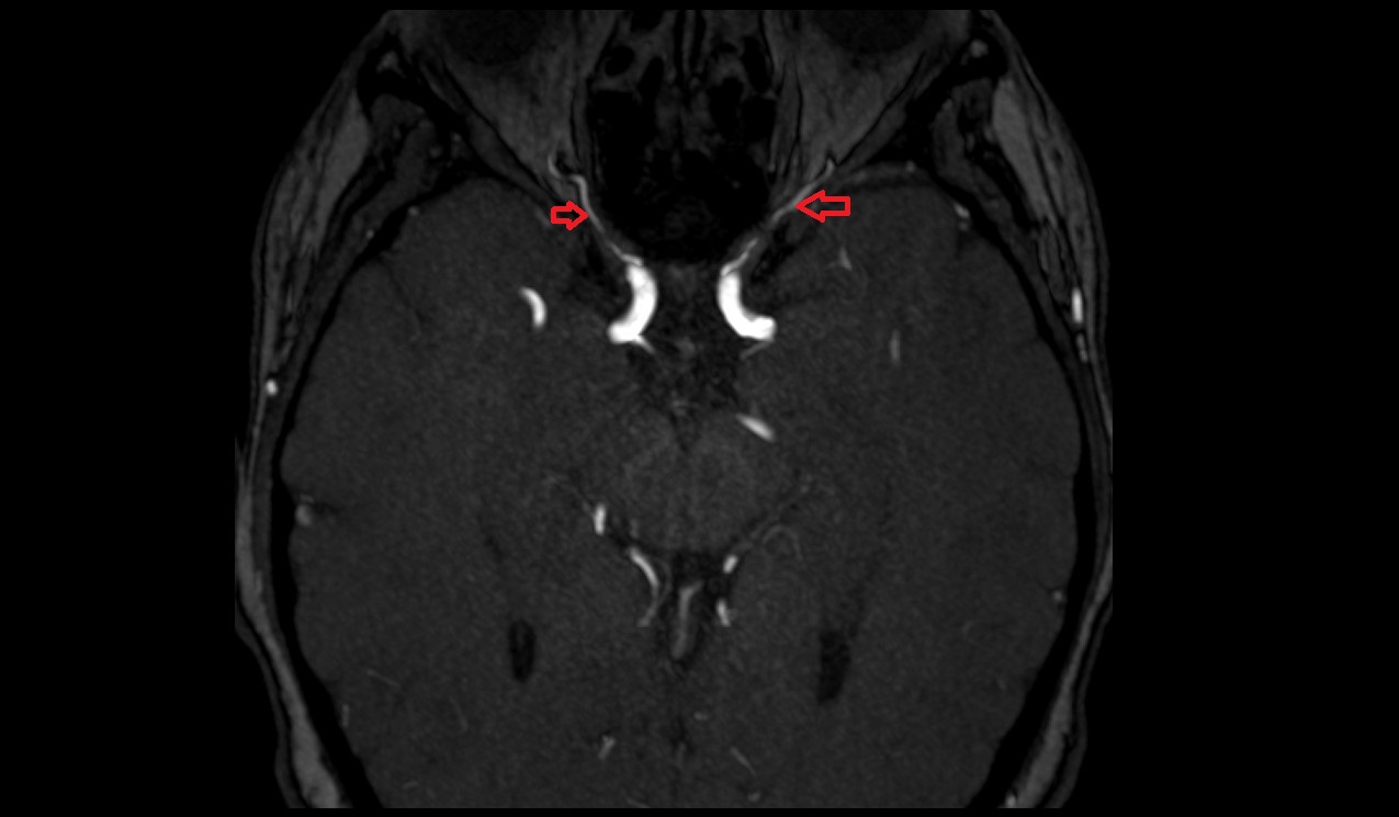 Ophthalmic artery MRI TOF axial image