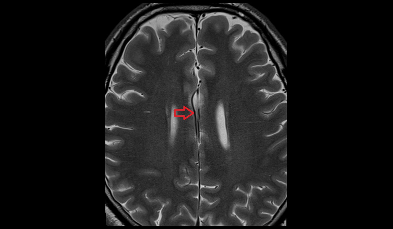 Pericallosal artery MRI axial T2 3T MRI image