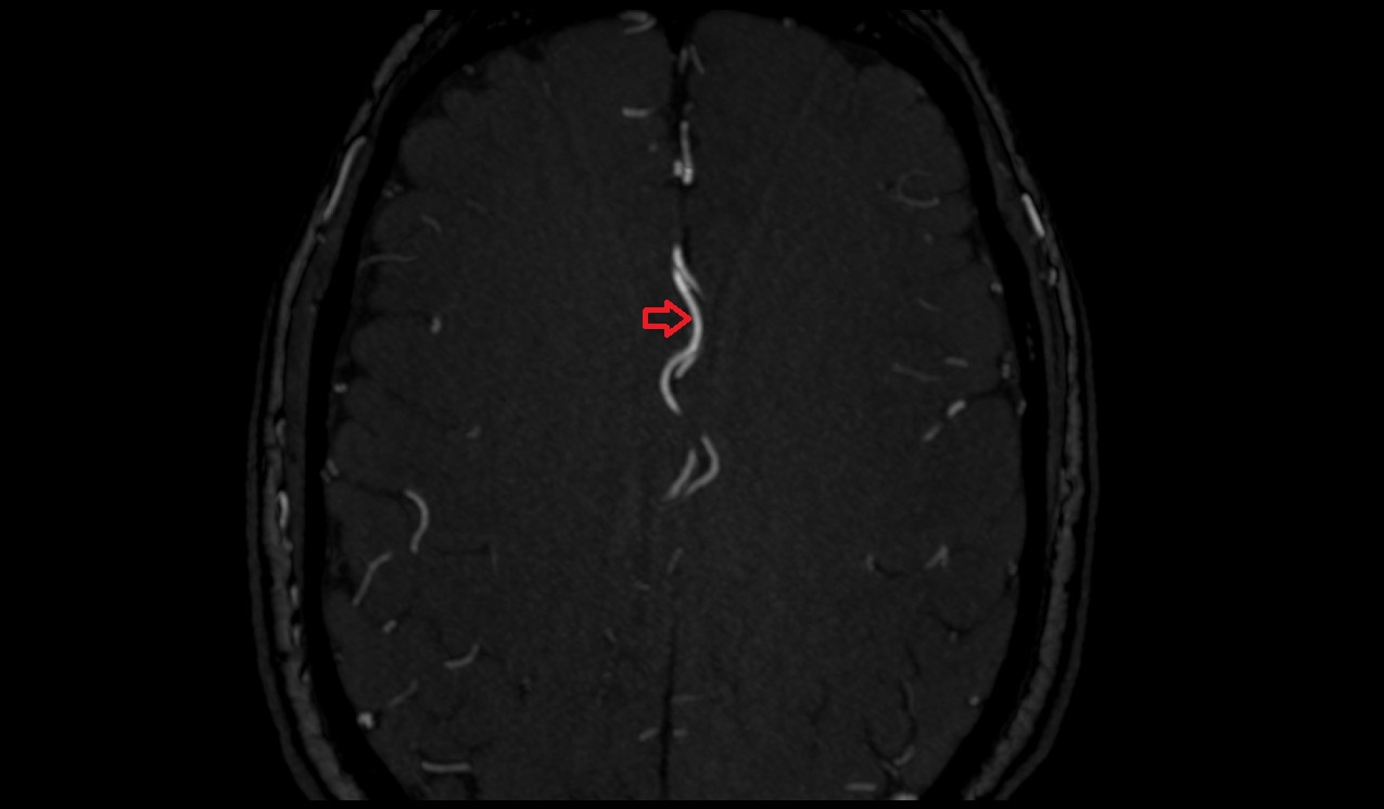 Pericallosal artery MRI axial TOF image