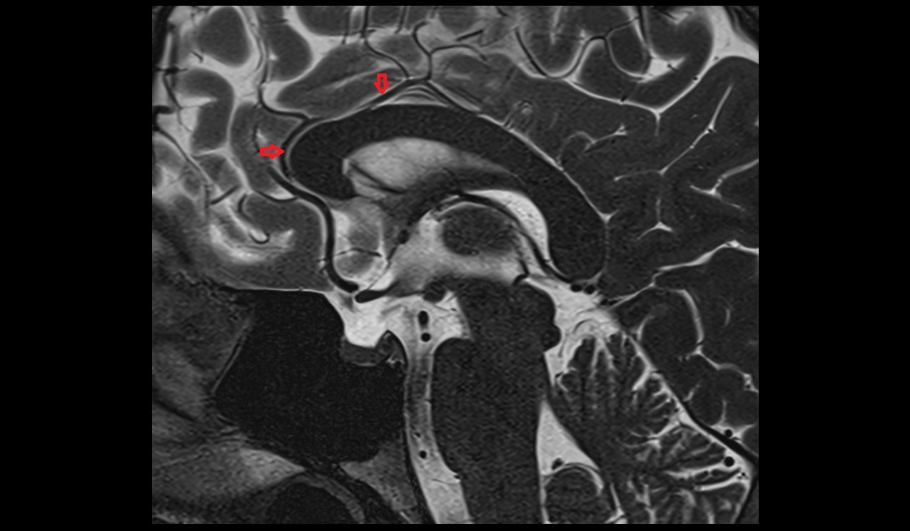Pericallosal artery MRI sagittal T2 3T MRI image